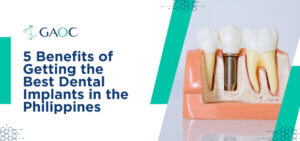 5 Benefits of Getting the Best Dental Implants in the Philippines