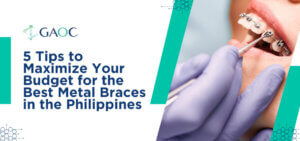 5 Tips to Maximize Your Budget for the Best Metal Braces in the Philippines