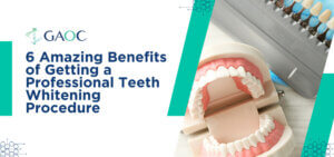 6 Amazing Benefits of Getting a Professional Teeth Whitening Procedure