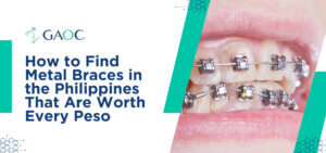 How to Find Metal Braces in the Philippines That Are Worth Every Peso