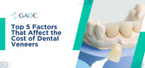 Top 5 Factors That Affect the Cost of Dental Veneers